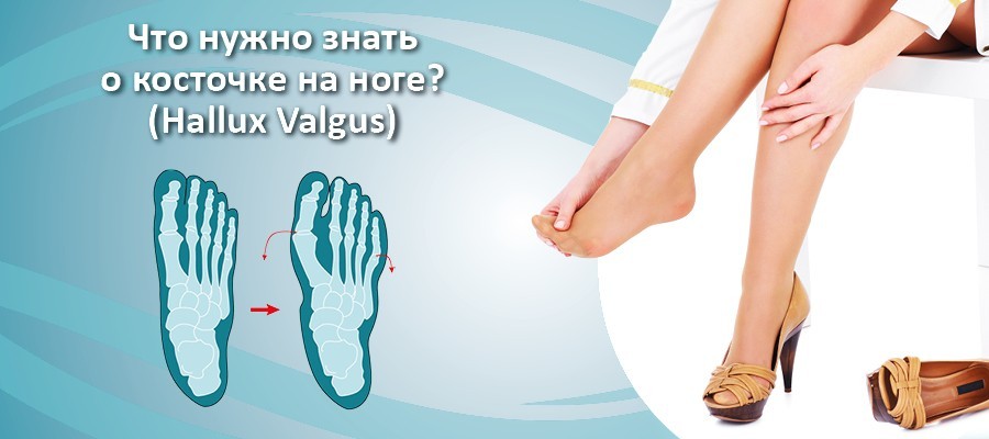 Косточка на ноге. Hallux Valgus. Как лечить?